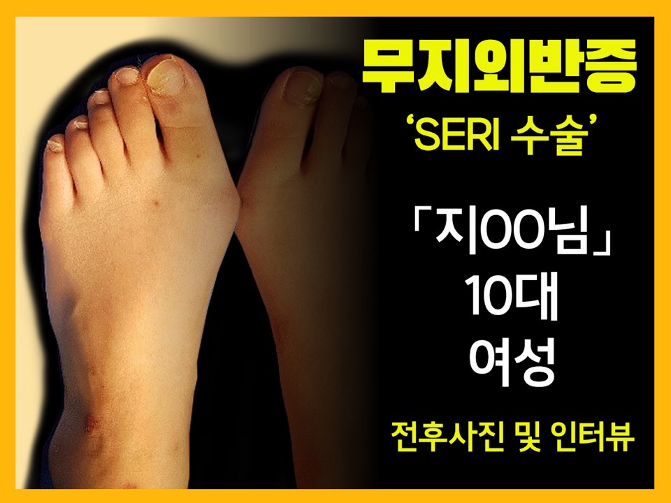 무지외반증 수술 [지OO님] - SERI