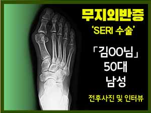 무지외반증 수술 [김OO님] - SERI